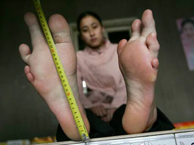 左右の足の形と大きさが全然違う女性 Gigazine