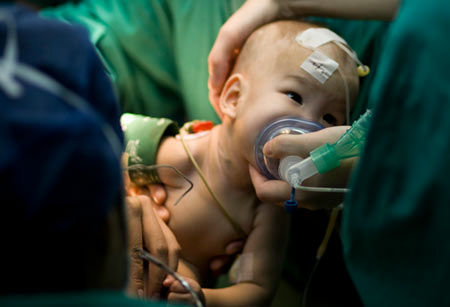 親に見捨てられた結合双生児の分離手術がインターネット上で生中継される Gigazine